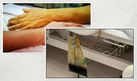 为什么胆囊切除后，医生要让你喝自己流出来的胆汁？